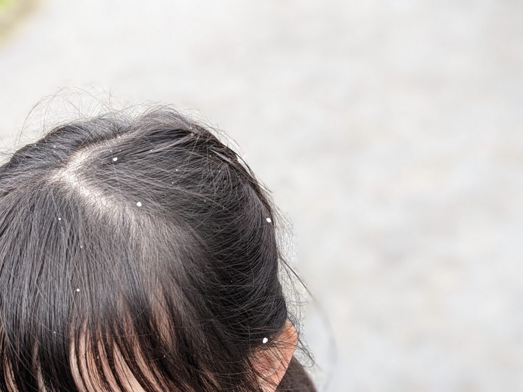 5歳女児の髪に付着した雪